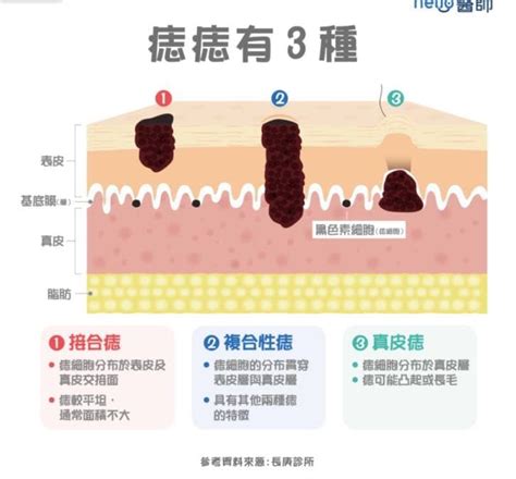 陰莖 黑痣|手術切除還是其他方法？陰莖黑痣、陰囊和包皮痣的處理方式